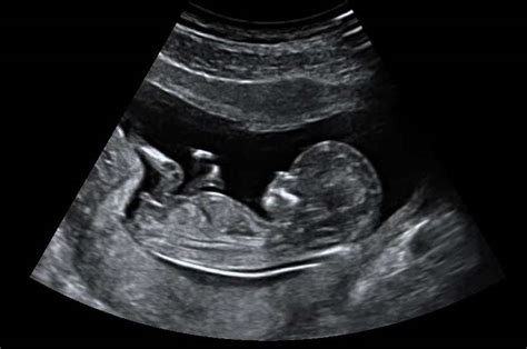 Échographie de grossesse